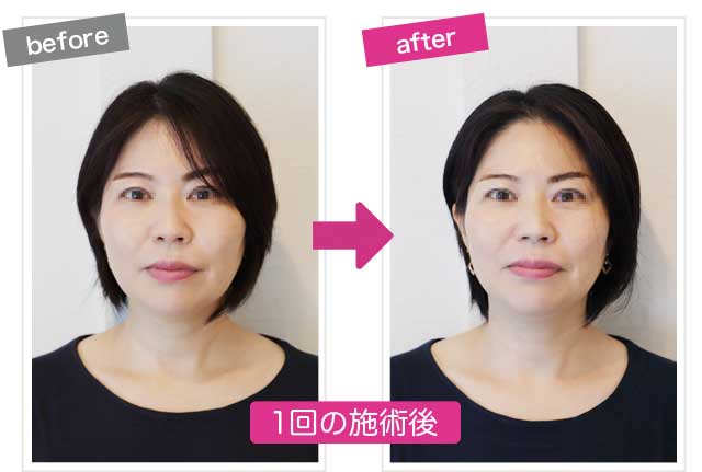 痛くない小顔矯正のbefore&after