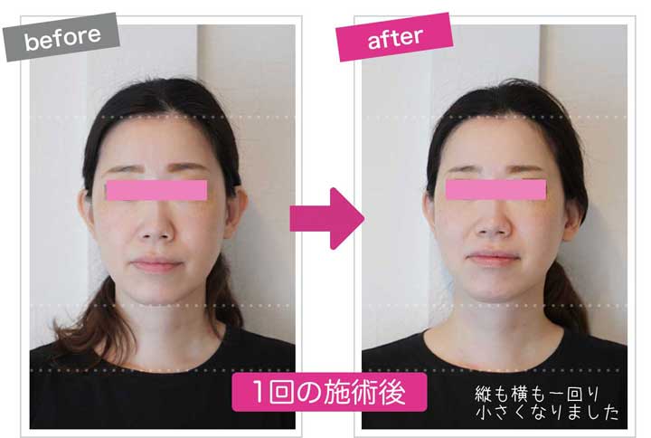 顔の縦幅まで小さくなっている小顔矯正のbefore&after画像