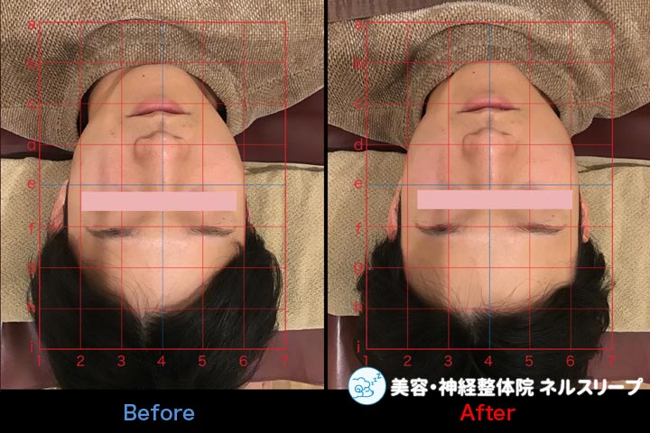 頭のゆがみが改善した小顔施術後のbefore＆after画像