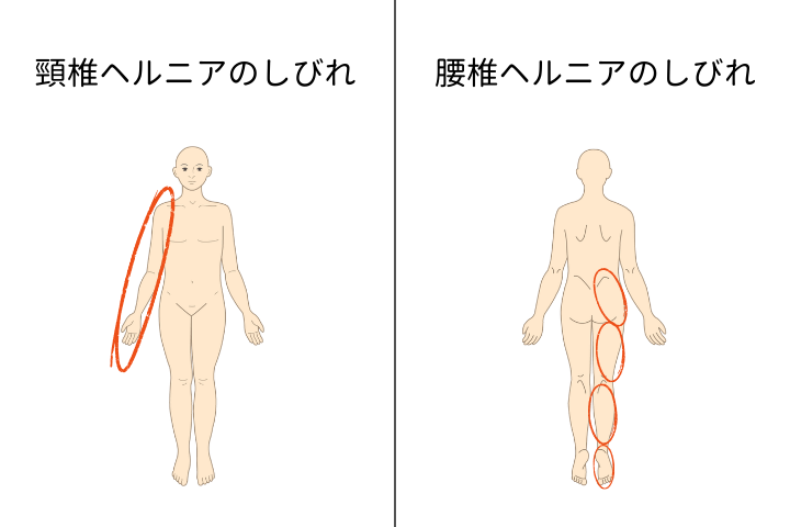 頸椎ヘルニアと腰椎ヘルニアのしびれが出る場所の違い