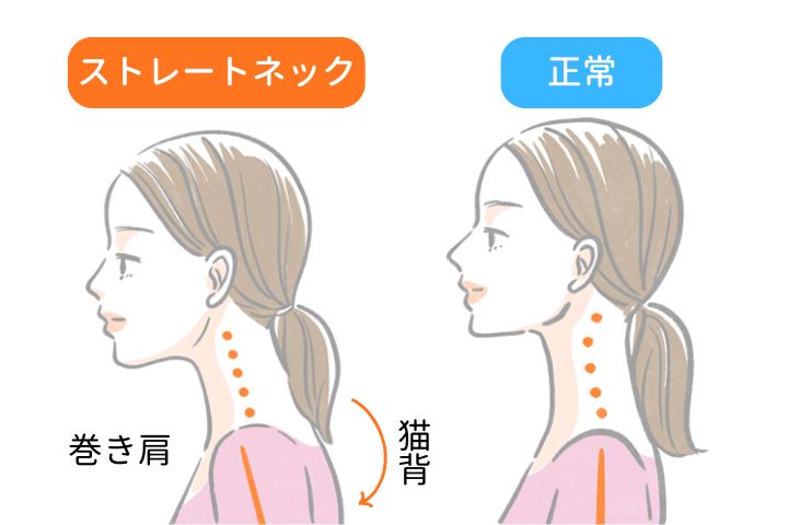 ストレートネックで猫背・巻き肩になるイメージ