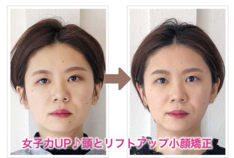痛くない小顔矯正を施術後の左右を比較した画像
