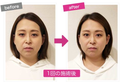 痛くない小顔矯正を施術後の左右を比較した画像